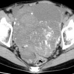 ６５歳女性 石灰化卵巣癌 CT検査
