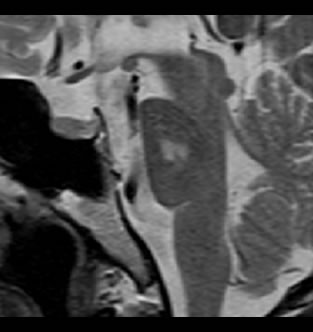 急性期：橋の梗塞　　CTでは正常画像所見 MRIで橋に異常信号