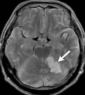 亜急性期の小脳梗塞　　T2強調像（MRI）