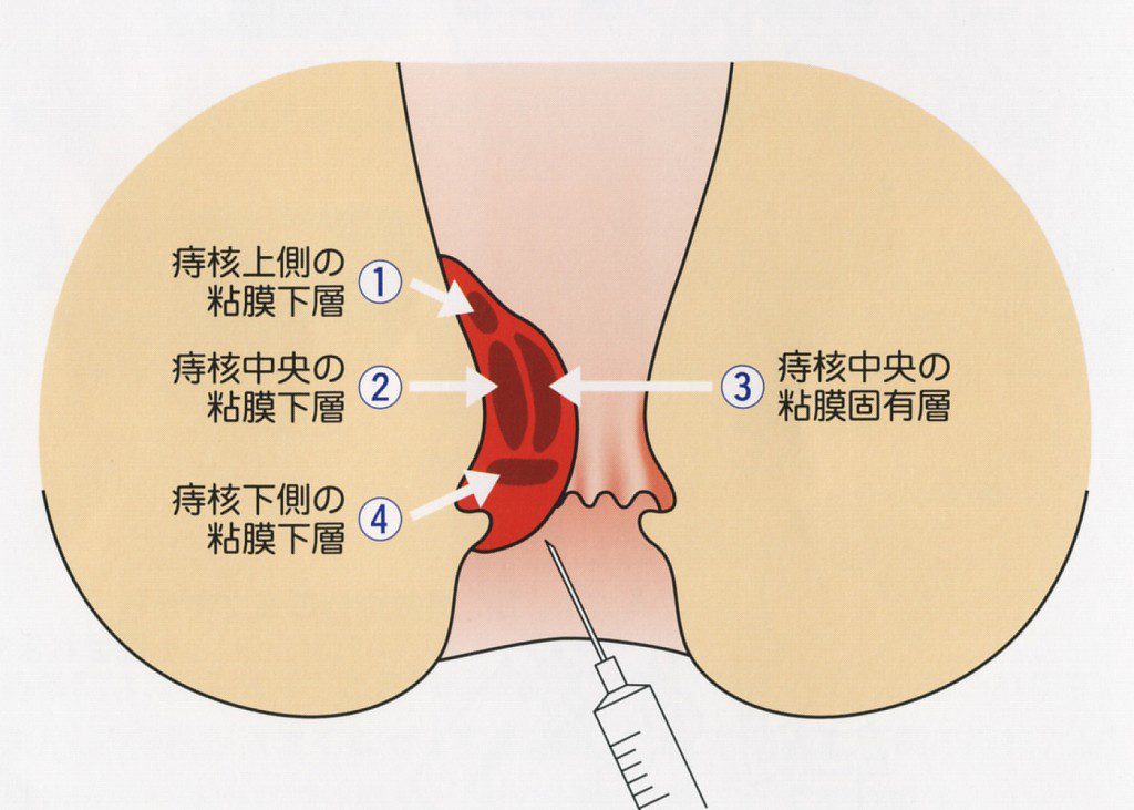 jion-4-m